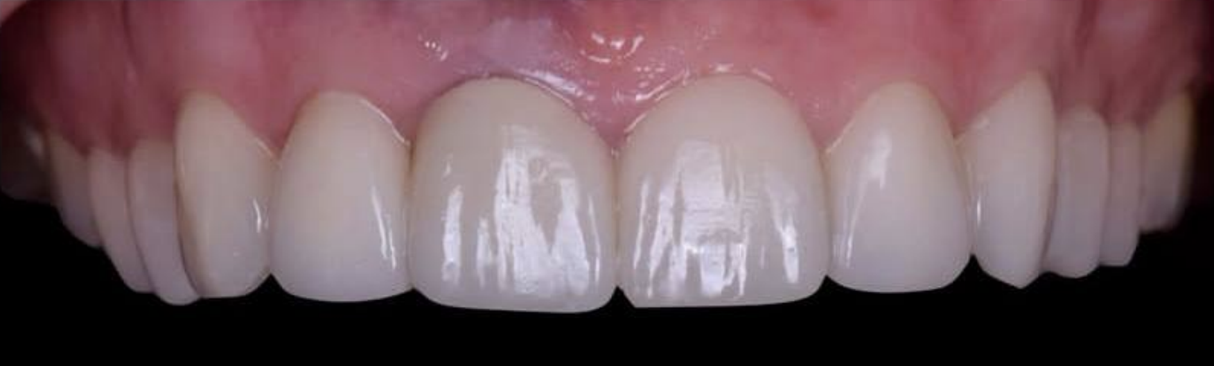 Стан шкіри після процедури №1