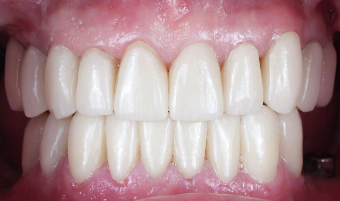 Стан шкіри після процедури №3